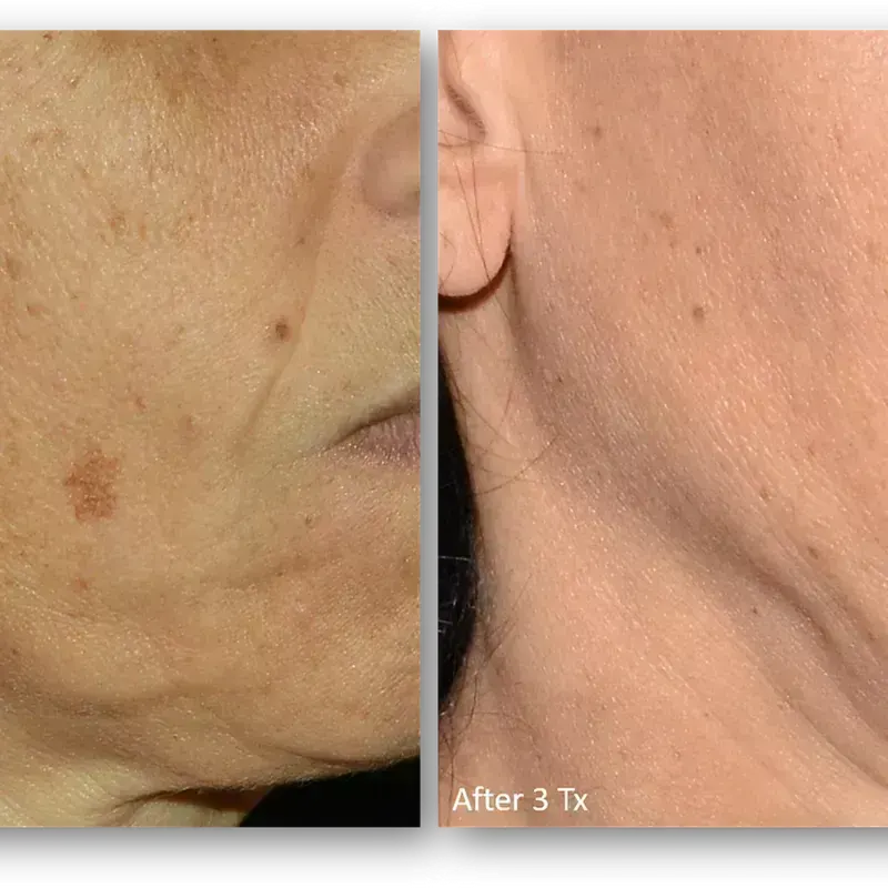 LaseMD Ultra before and after result 2