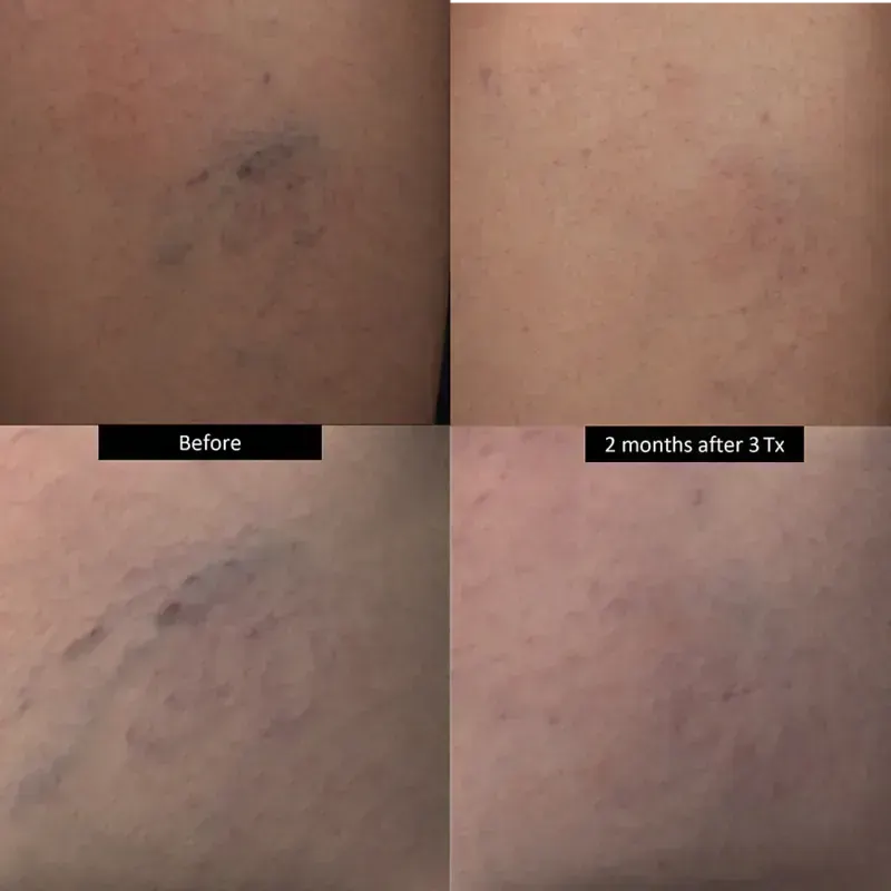 DermaV before and after result
