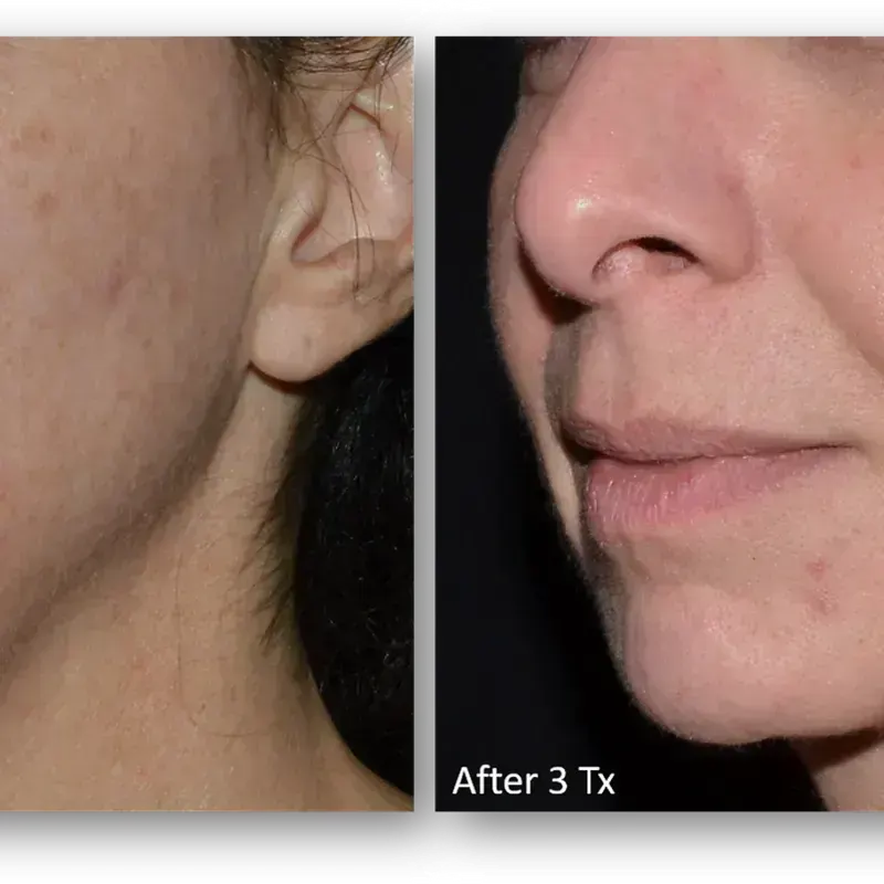 LaseMD Ultra before and after result 7