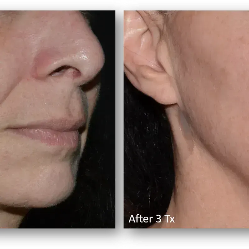 LaseMD Ultra before and after result 9