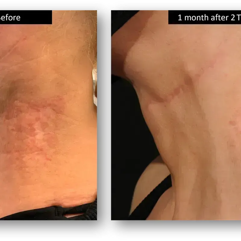 DermaV Laser before and after result 3