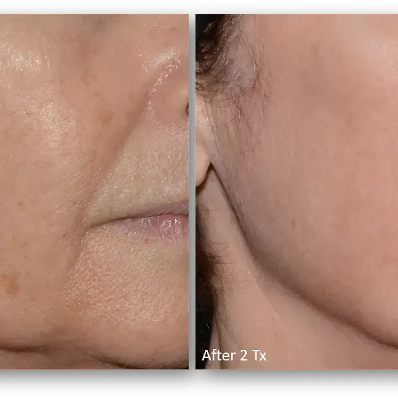 LaseMD Ultra before and after result 3