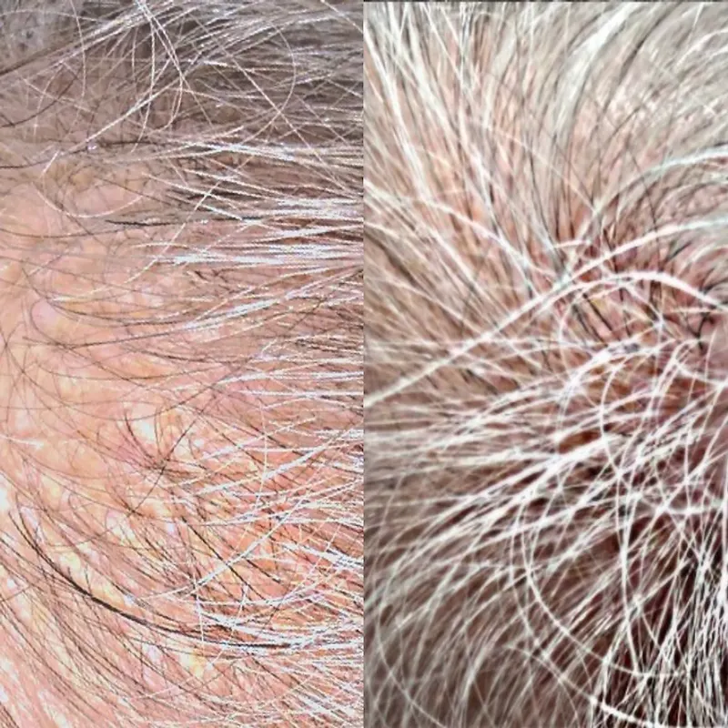 Hair loss before and after treatment - patient 3
