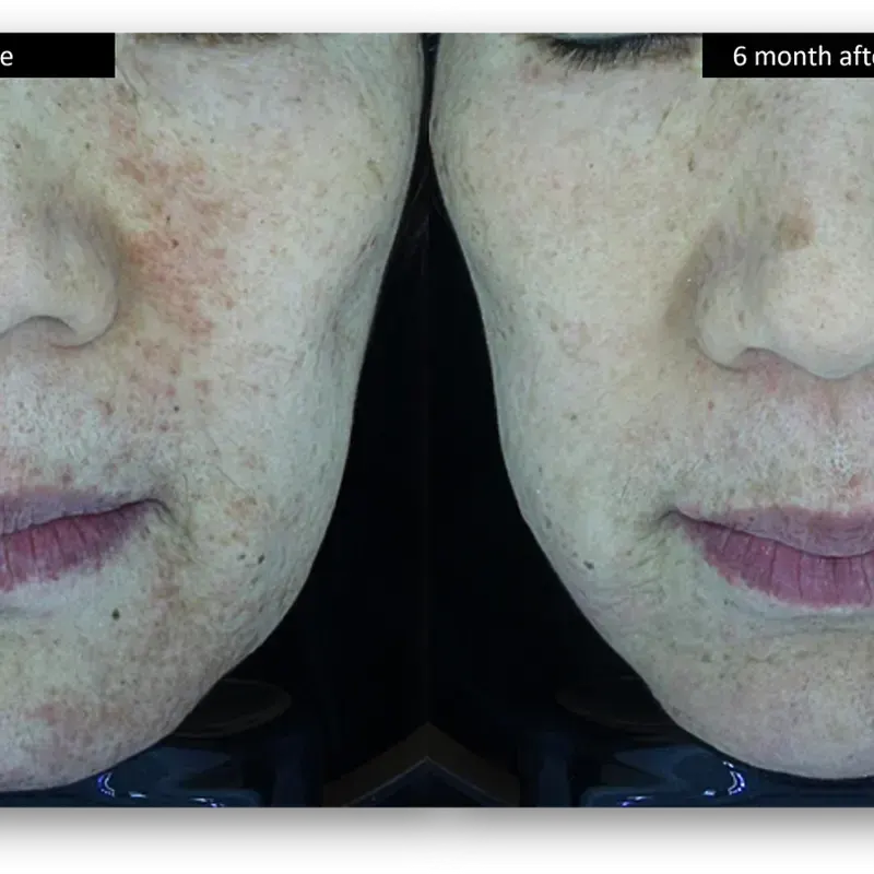 DermaV Laser before and after result 4