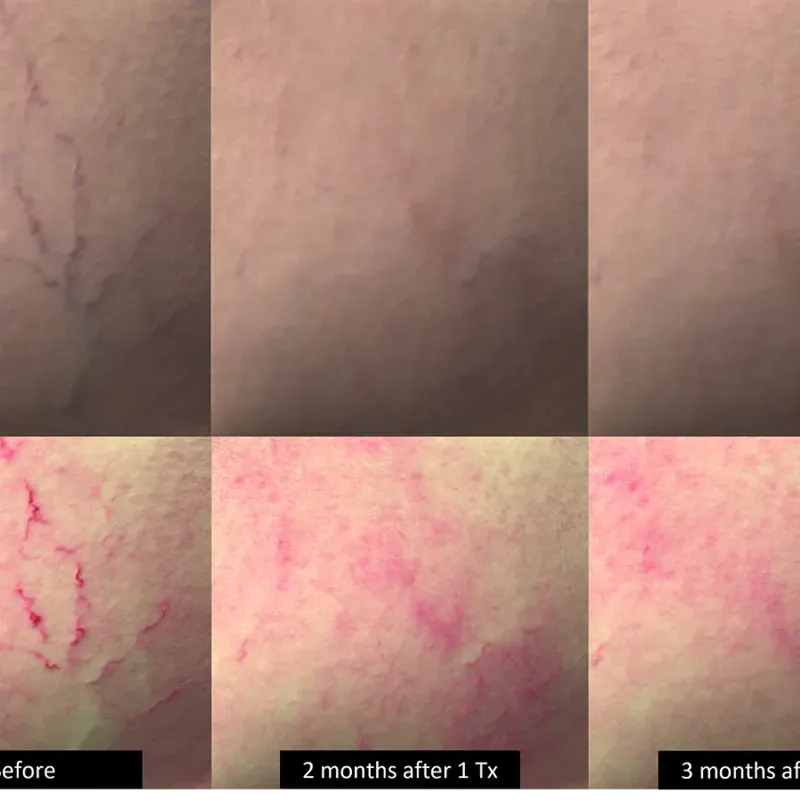 DermaV Laser before and after result 5