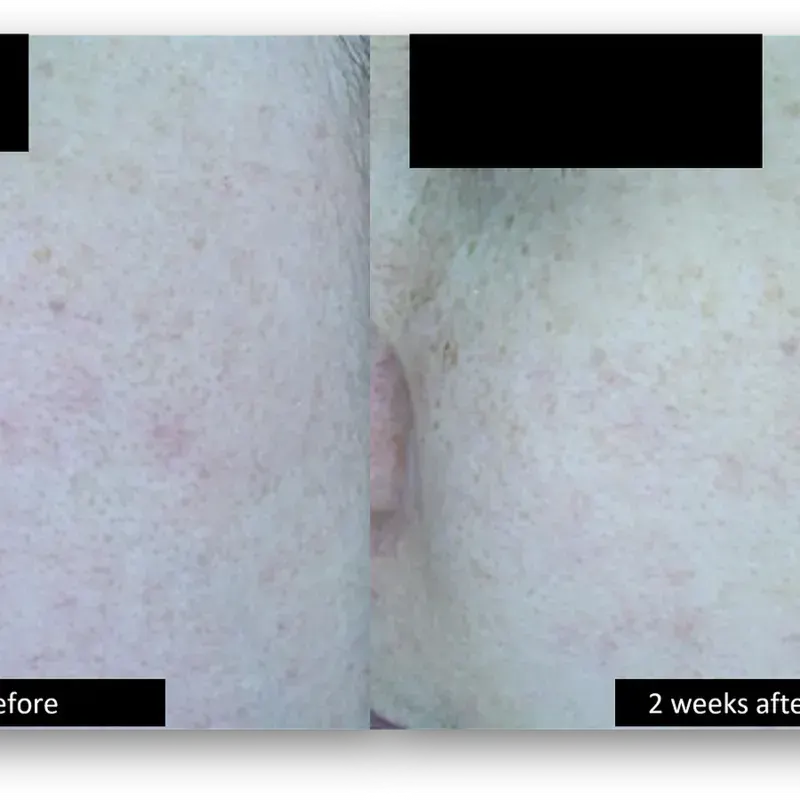 DermaV Laser before and after result 10