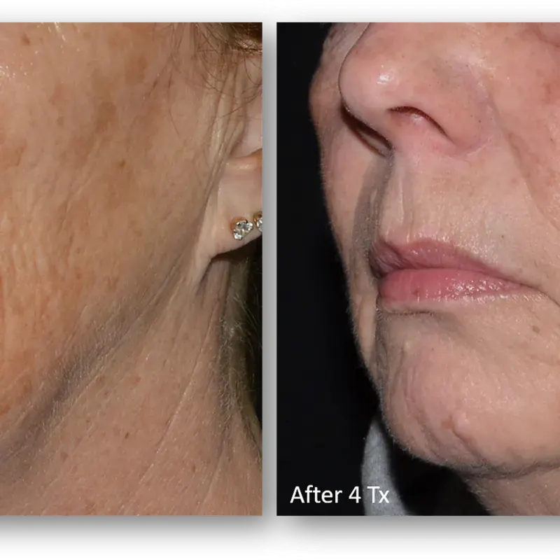LaseMD Ultra before and after result 15