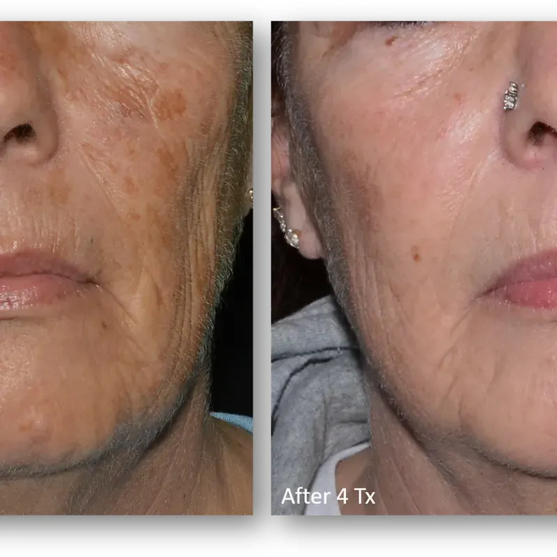 LaseMD Ultra before and after result 14