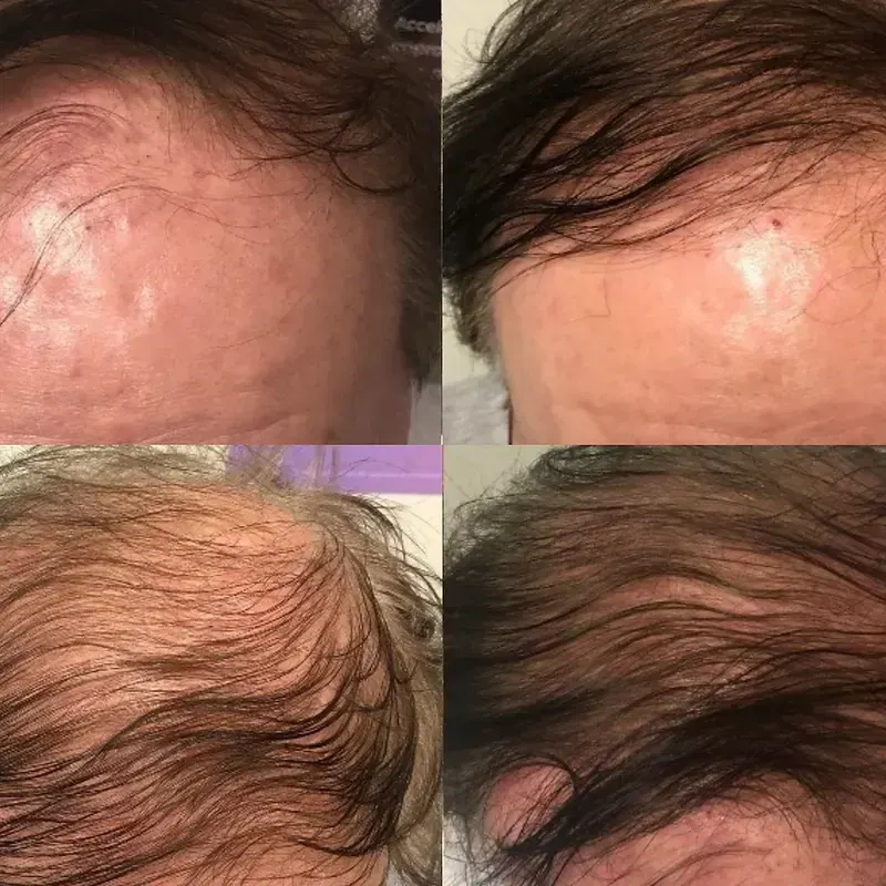Hair Loss before and after result