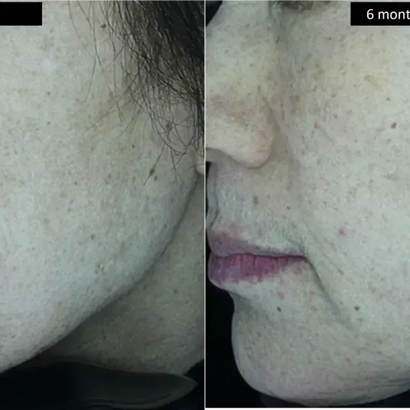 DermaV Laser before and after result 2