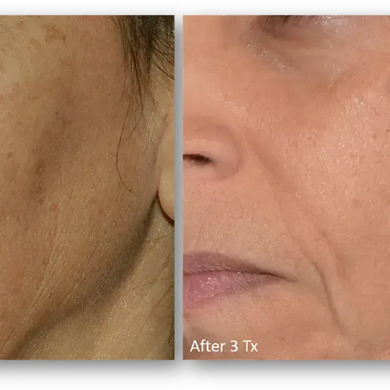 LaseMD Ultra before and after result